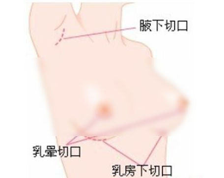 韩国JAYJUN整形外科的隆胸技术怎么样呢？