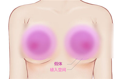 韩国ID假体隆胸技术好吗