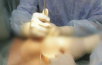 假体隆胸手术过程