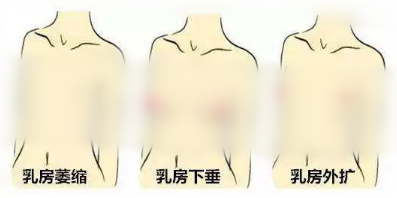 朴俊亨隆胸类型示意图
