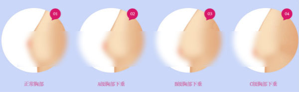 韩国乳房悬韧带怎样修复，自己锻炼有用么？