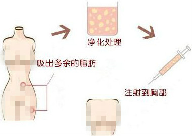 自体脂肪隆胸有没有危害，韩国哪些医院手术效果好？
