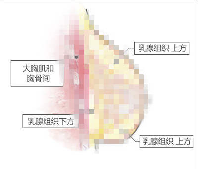 自体丰胸手术价格跟罩杯有影响吗？想要C杯一般多少钱