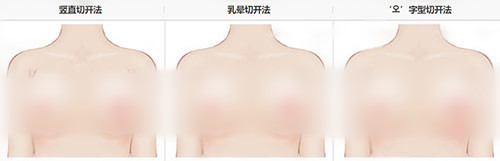 胸部下垂怎么办？韩国必妩产后乳房修复真人案例为你解答