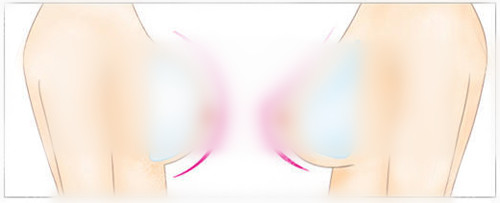 圆形假体和水滴型假体隆胸