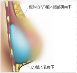 假体丰胸双层平面植入法