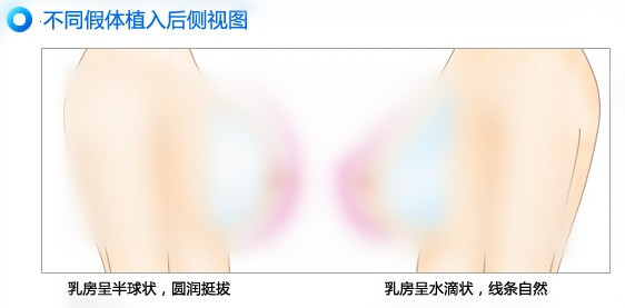 韩式假体隆胸术