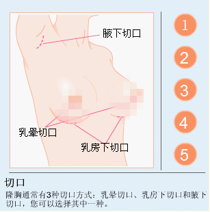 假体隆胸切口