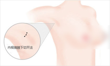 韩国爱琳整形外科假体隆胸优势分析