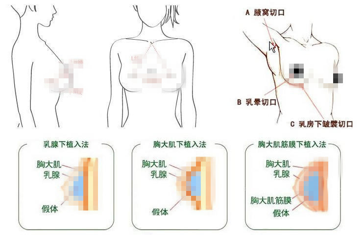 假体隆胸后到底需不需要按摩？