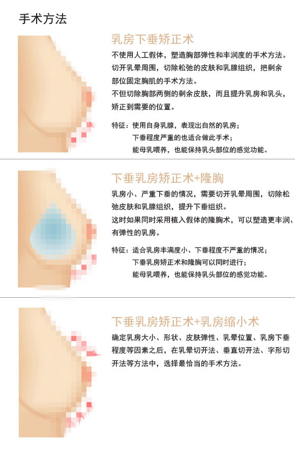 乳房下垂矫正手术方法