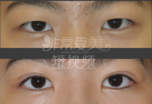 韩国will整形外科双眼皮手术案例