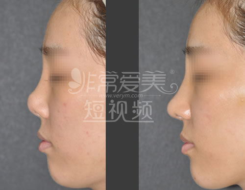 韩国will整形外科鼻部整形手术案例
