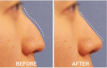 韩国lucea整形医院鼻部矫正手术对比案例