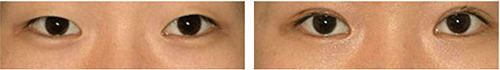 韩国lucea整形外科眼部手术对比日记