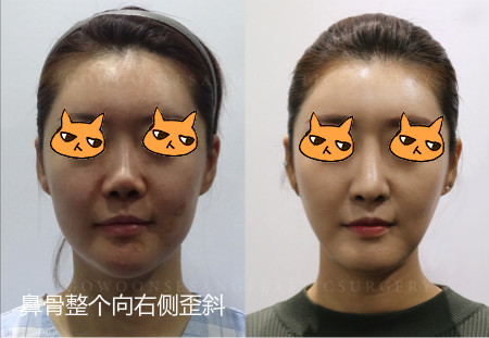 韩国歪鼻手术效果对比