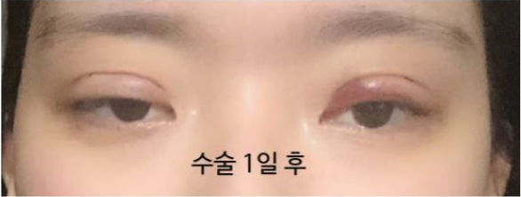 韩国美丽的人双眼皮术后第一天