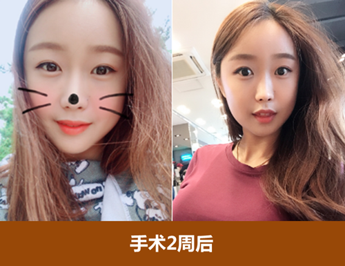 网友分享：在韩国ID做vline+颧骨缩小+脂肪填充的整形经历