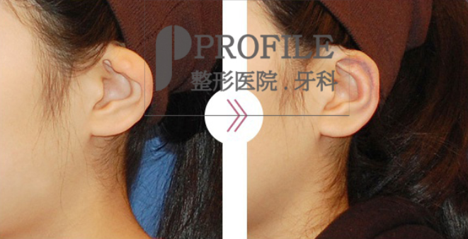 韩国profile医院耳朵整形案例