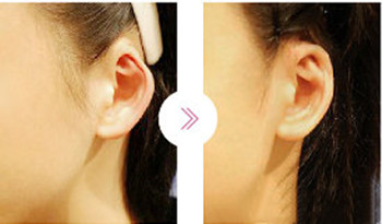 小耳畸形通常这么做！韩国profire郑在皓做小耳畸形多年！