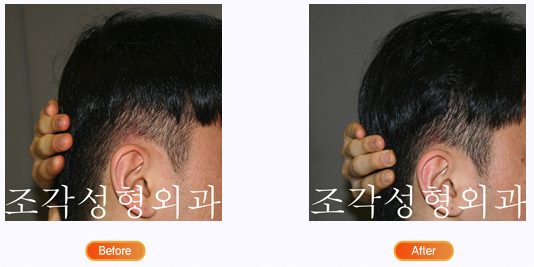 韩国雕刻整形外科后脑勺对比