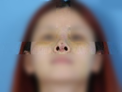 假体隆鼻术后出现感染照片