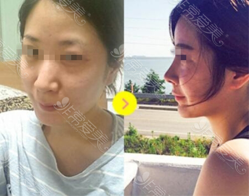 韩国自然主义假体+自体软骨隆鼻术后照片