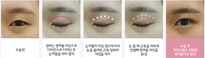 韩国StemKay整形外科眼部手术好吗？