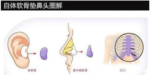 韩国隆鼻手术视频 自体软骨隆鼻材料哪种更好
