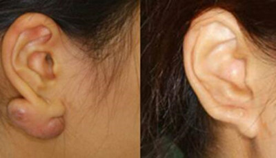 韩国清潭优耳垂疤痕瘤治疗对比图