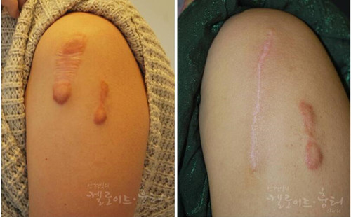 韩国清潭优胳膊疤痕瘤治疗对比图