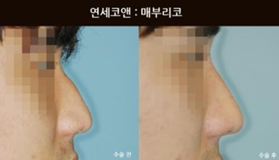 韩国Yonsei C＆ENT整形外科男士鼻部矫正照片