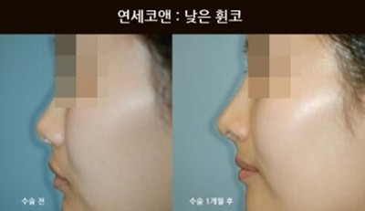 韩国Yonsei C＆ENT鼻部整形效果示意图