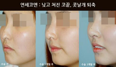 韩国Yonsei C＆ENT鼻部矫正前后对比照片