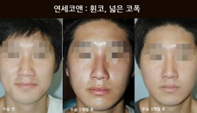 韩国Yonsei C＆ENT整形外科鼻部矫正前后照片