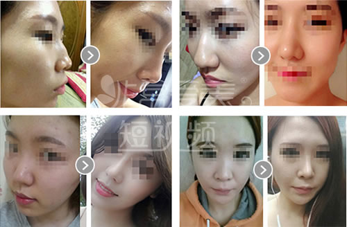 韩国will整形外科隆鼻手术案例