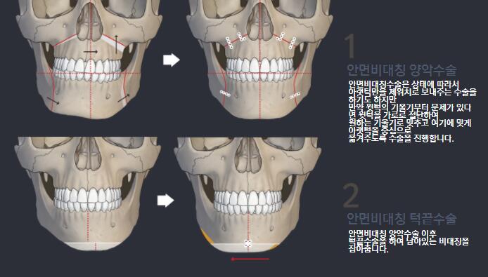 韩国EU整形外科官网案例流出，面部不对称这样矫正才好看！
