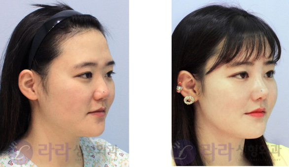 韩国lara整形外科医院隆鼻案例