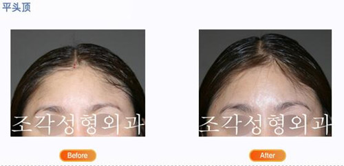 韩国雕刻整形外科平头顶术后效果图