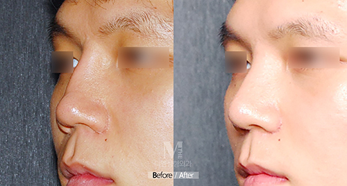 韩国迪美（美佳）整形外科男士隆鼻修复手术案例