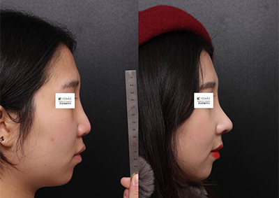 韩国清新整形外科隆鼻前后照片
