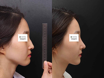 韩国清新整形外科驼峰鼻矫正前后对比照片