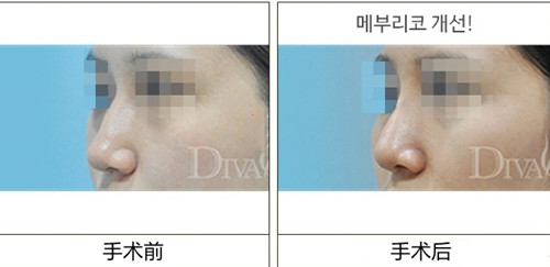 韩国DIVA整形外科玻尿酸隆鼻真人案例