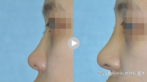 韩国DIVA整形外科鼻综合整形真人案例