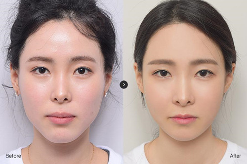 韩国EU口腔颌面整形V脸手术日记