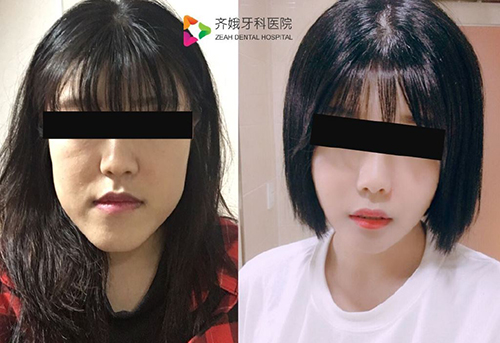 韩国齐娥牙科双鄂轮廓手术案例对比