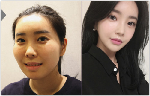 韩国faceline面部轮廓整形真人案例