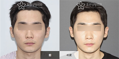 韩国秀梦整形外科男士颧骨整形手术对比日记