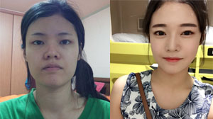 韩国巴诺巴奇隆鼻修复案例对比图