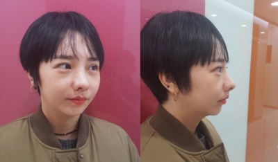 韩国清新医院鼻修复整形术后照片